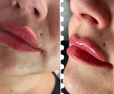 Dermal fillers contain hyluronic acid (which the body produces naturally) to restore youthful, smooth, plump skin. Dermal fillers usually last around 6 months or more, the body naturally breaks down hyluronic acid over time.. Call  Alsorts Lush Aesthetics on 07969 509 319 