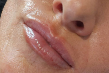 Lip fillers are designed to enhance your lip shape, increase lip fullness and can help improve symmetry. The process of aging can cause lips to become thinner and lose their fullness.