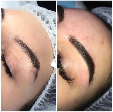 Microblading is an advanced eyebrow treatment using a specialist hand tool; a micro-blade made up of multiple needles creating bespoke, crisp hair strokes.